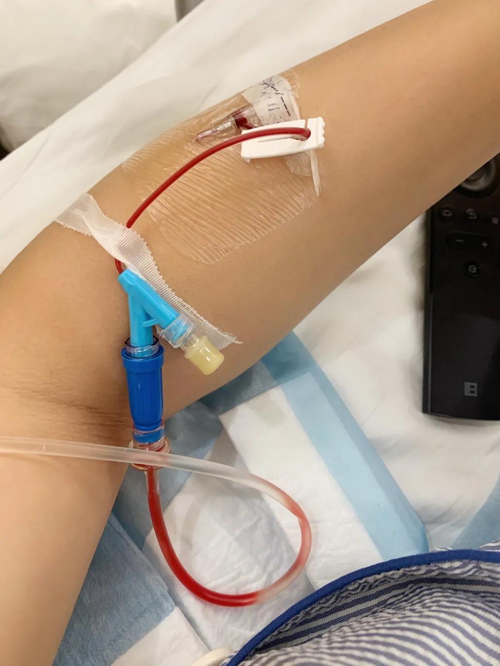 一张图看懂跟腱断裂,跟腱断裂日常