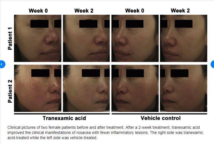 美白精华传明酸,美白传明酸