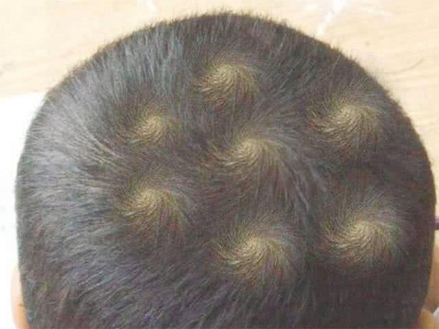 孩子头顶两个旋代表什么,头顶旋多的孩子有什么意思