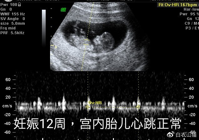 双胞胎，一个在宫内，一个躲宫外。孕妈生命垂危，医生妙手回春！