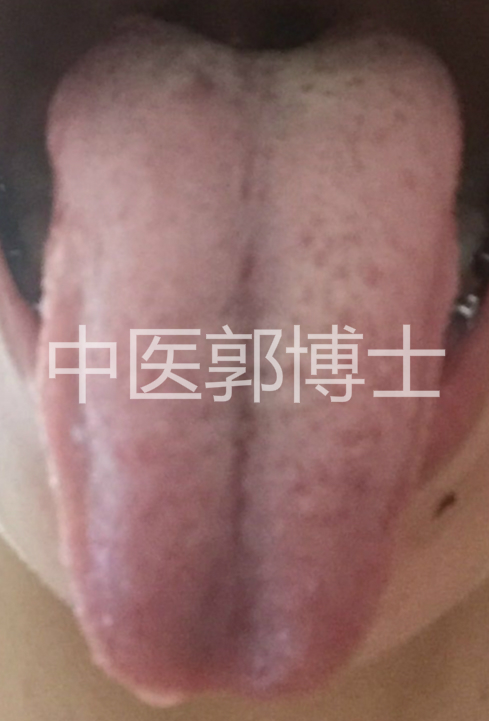月经后一周喝中药又出血,例假淋漓不尽吃黄体酮还出血