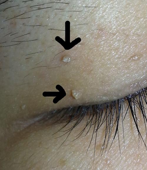 眼睛上长了黄色小粒,眼睛里面有黄色的麦粒肿怎么搞