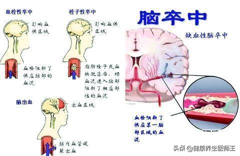生命健康有哪些方面,临床症状脑血栓形成