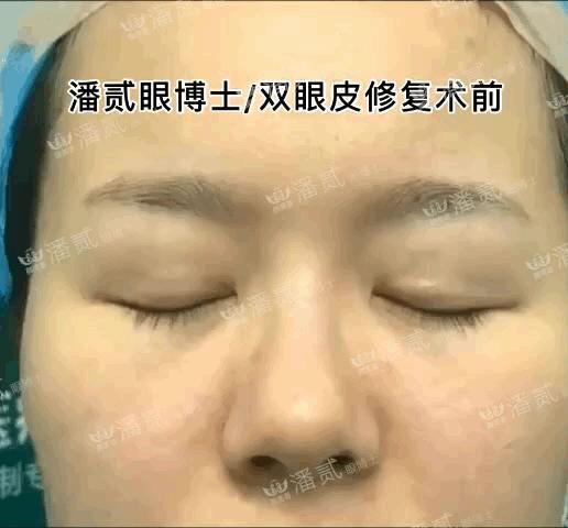 韩式精雕微创双眼皮,韩式微创双眼皮恢复过程真实记录
