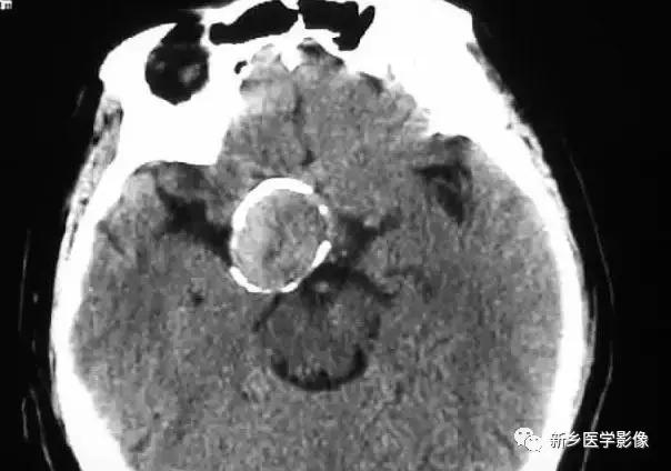 颅内有钙化怎么治疗,34岁脑部有钙化正常吗