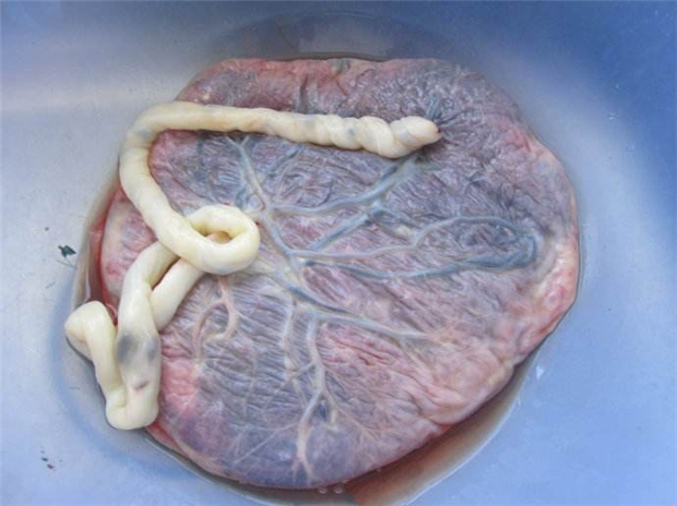 生完宝宝胎盘怎么处置,生完宝宝胎盘怎么处理合适