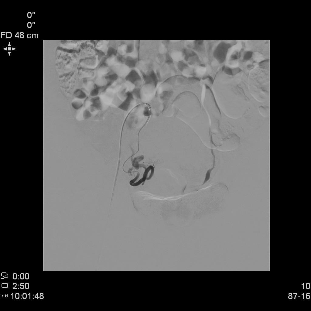 子宫肌瘤介入栓塞对子宫影响,子宫肌瘤介入栓塞治疗的危害