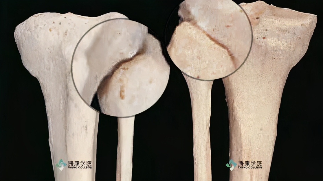 膝关节内侧副韧带解剖,膝关节解剖及常见损伤