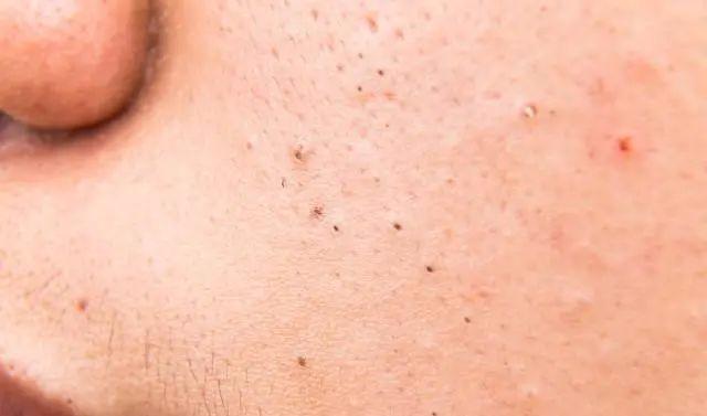 毛孔粗大有黑头最有效的方法,毛孔粗大有黑头最简单的解决方法