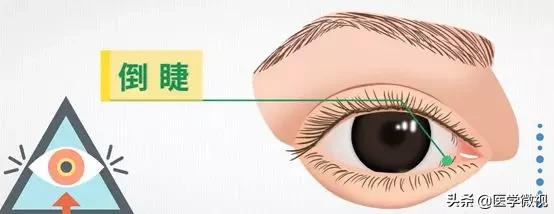 睫毛长倒睫怎么办,睫毛倒长扎眼睛怎么处理