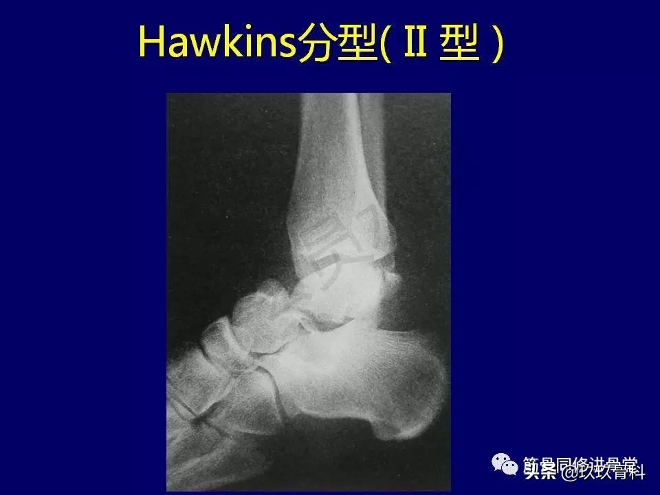 距骨骨折的治疗原则,距骨骨折如何调理