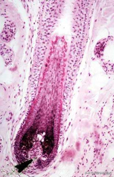 不是所有秃头都遗传,遗传脱发和脂溢性脱发一样吗
