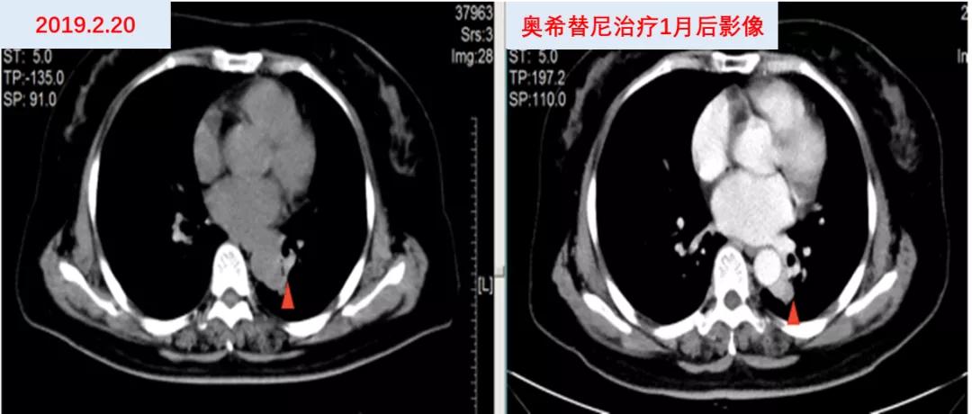 口服长春瑞滨出现耐药性了,口服长春瑞滨要吃多久