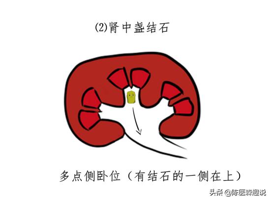 发现肾结石怎样治疗更好,发现肾结石怎么办