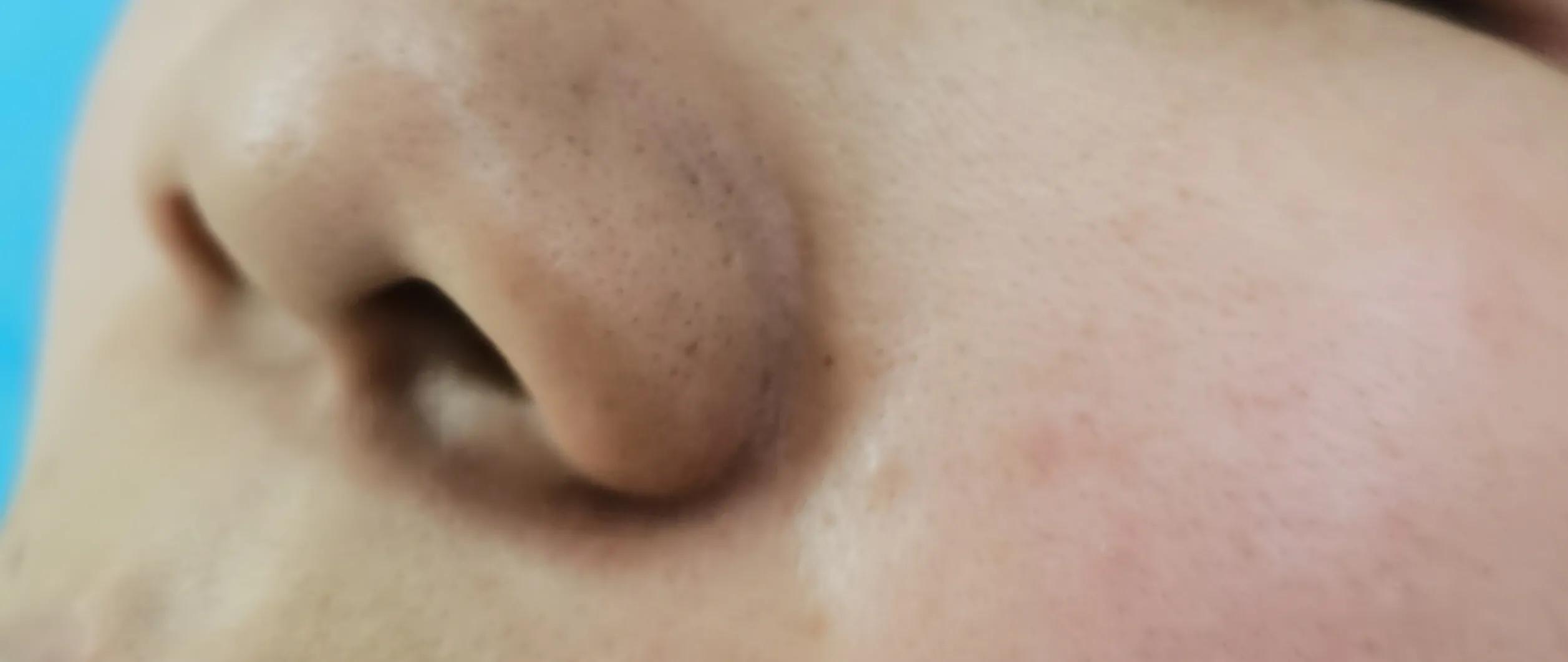 整形美容手术,鼻翼缩小术能减轻鼻基底凹陷吗