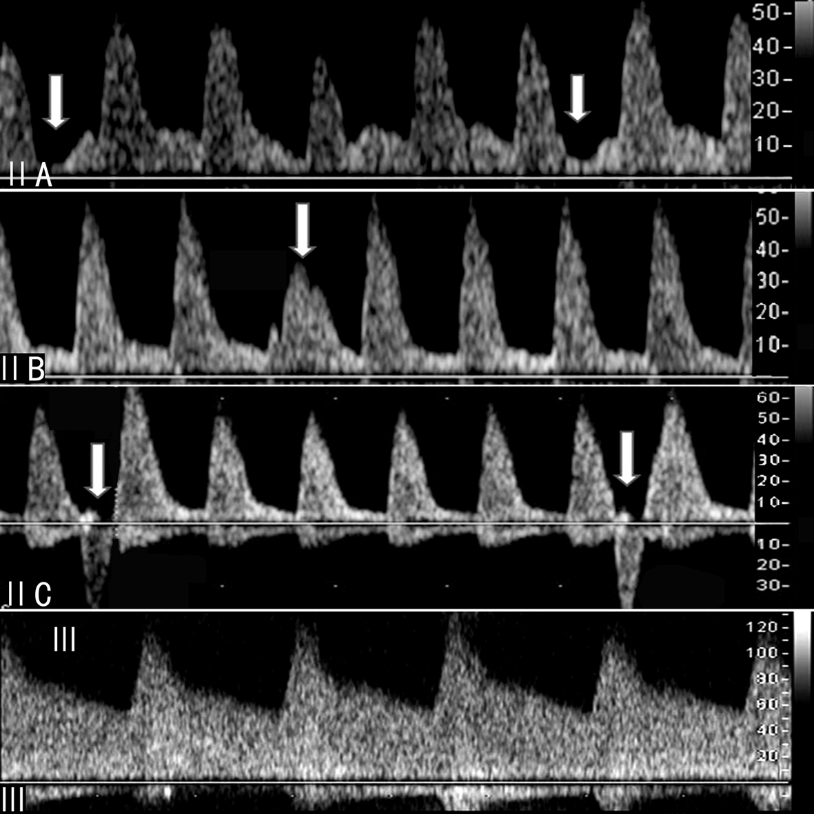 胎儿系统超声检查彩色多普勒,胎儿多普勒超声的一些数据