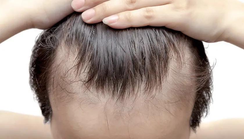 雍禾植发后枕部秃了,2亿人被脱发困扰