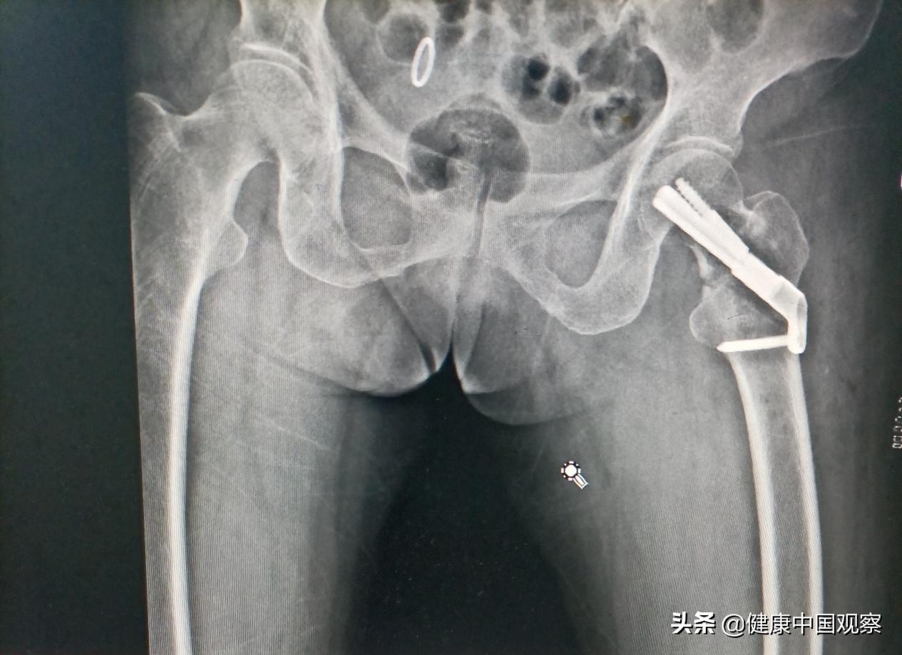 江苏省启东市第三人民医院：微创手术治愈高龄骨折患者