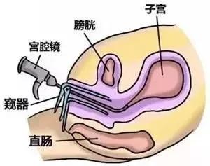 宫腔粘连——备孕的隐形杀手