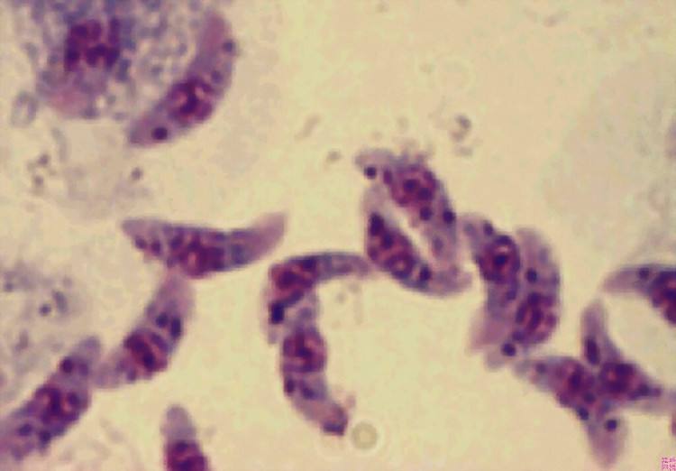 新生儿各种黄疸的鉴别和治疗,小孩黄疸不是病理性的怎么处理