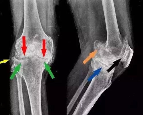 膝关节为何会退变?生活中少做哪些事,可预防膝骨关节炎?
