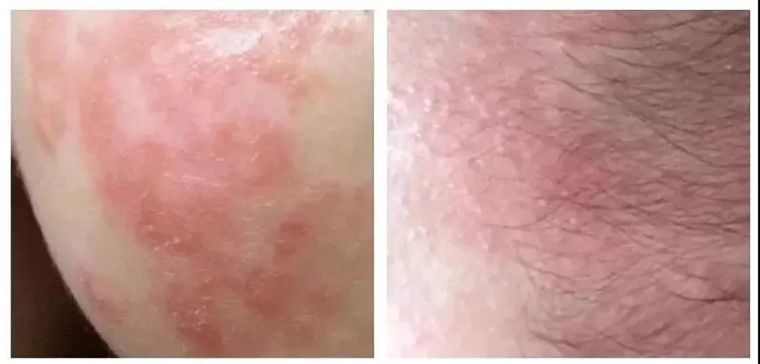 冬季婴儿痱子如何护理,孩子冬天起痱子了怎么最快消除