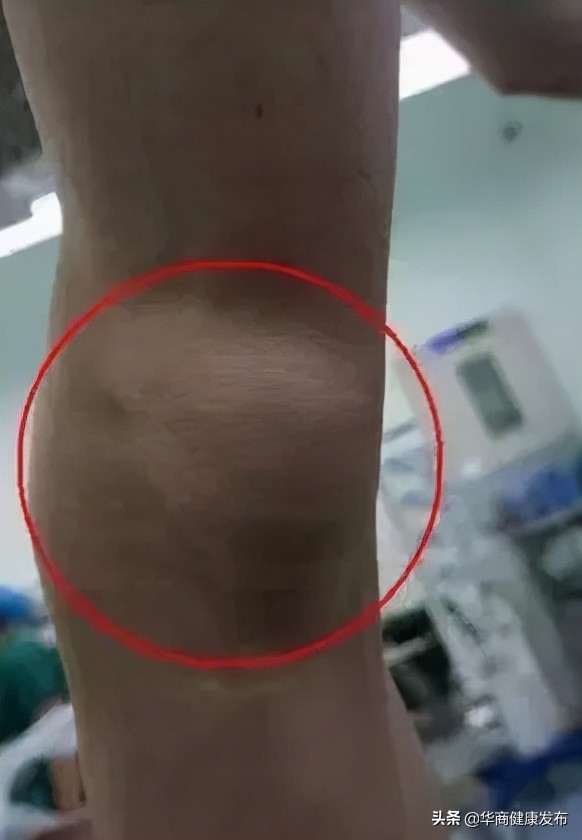 膝盖腘窝囊肿多大要手术,腘窝手术切口