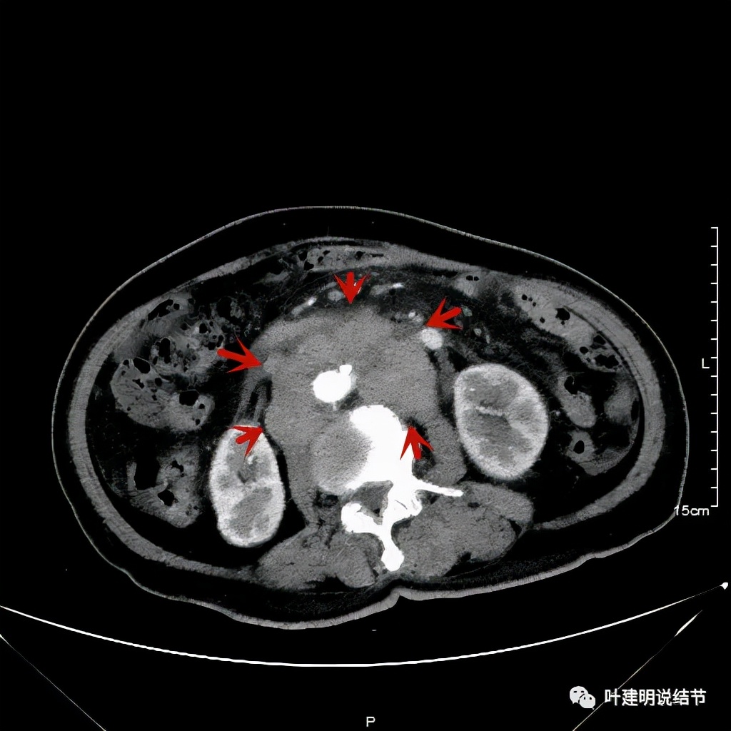 特瑞普利单抗食管癌成功案例,特瑞普利单抗治疗食管癌效果好吗