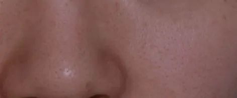 鼻头毛孔粗大如何改善缩小毛孔,皮肤毛孔粗大出汗可以缩小毛孔吗