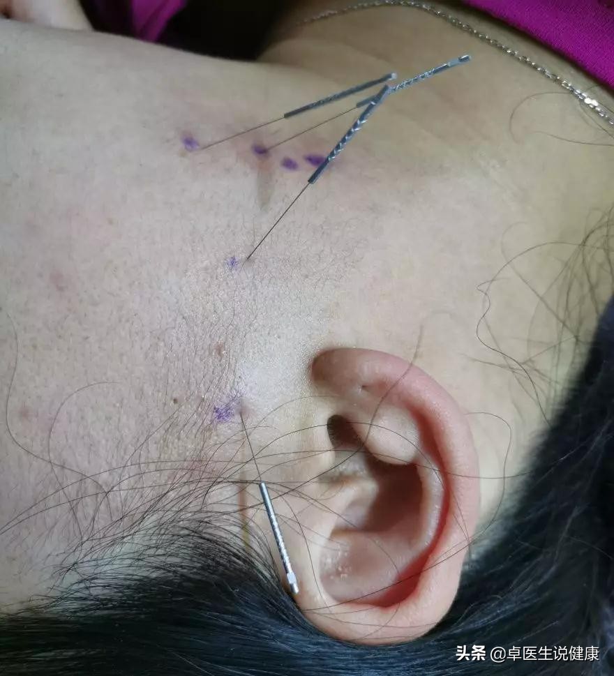 中医颊针教学,腰大肌损伤针灸图解