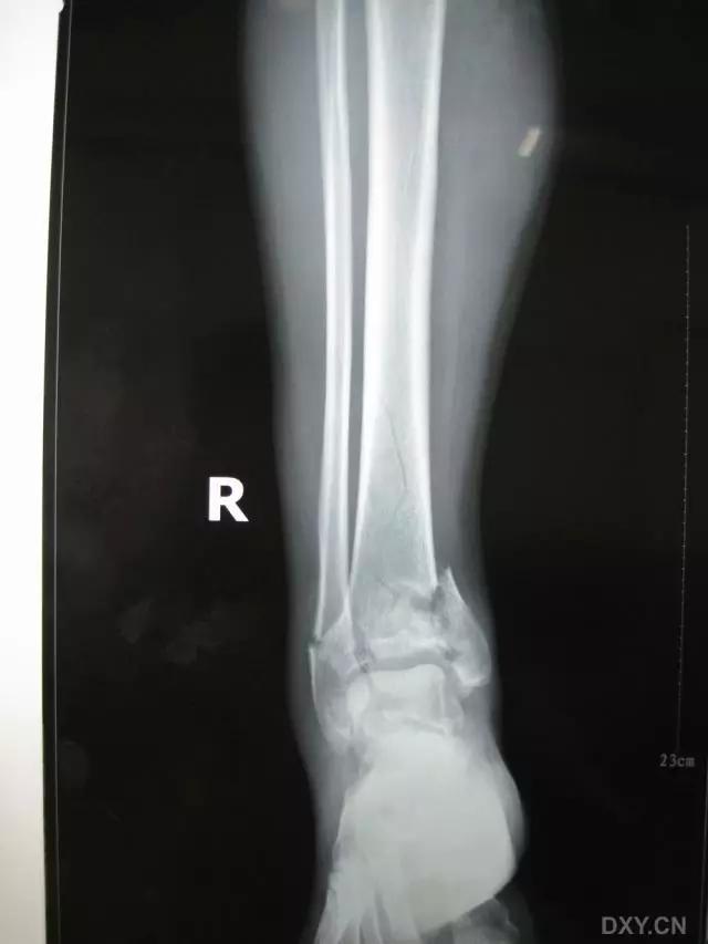 几种严重骨折医学名称,常见的骨折有哪些名称