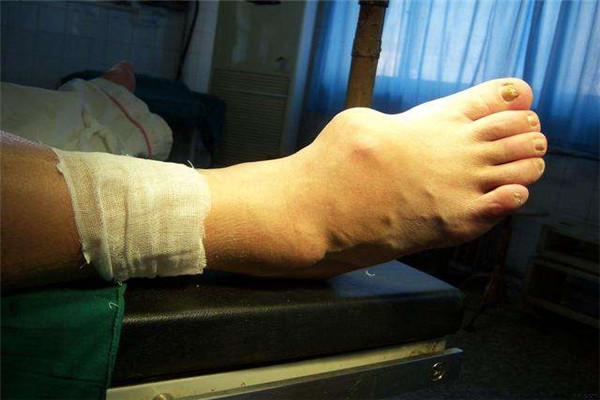 痛风石感染流脓需要手术吗,手指痛风石破溃