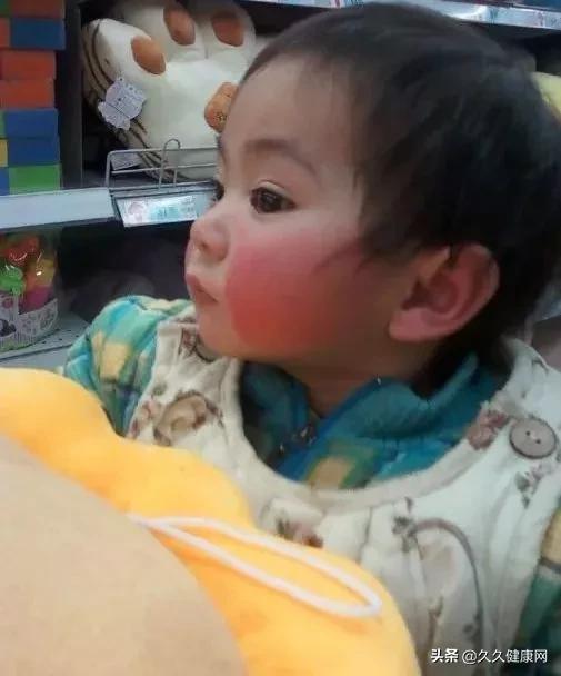 宝宝红脸蛋是食火吗,宝宝红脸蛋是因为角质层受损了吗
