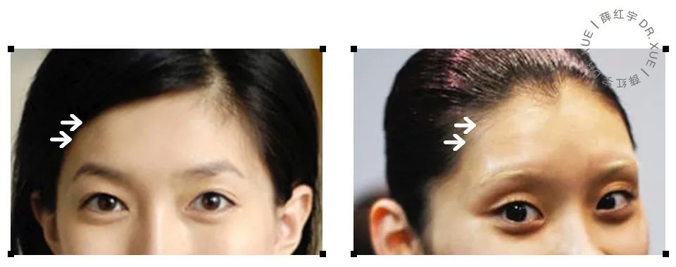 额头饱满跟不饱满一样吗,额头宽太阳穴饱满有什么说法