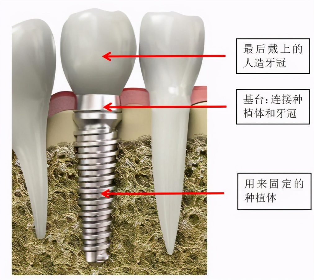 牙坏了怎么办？种植牙原来还有这些“讲究”！
