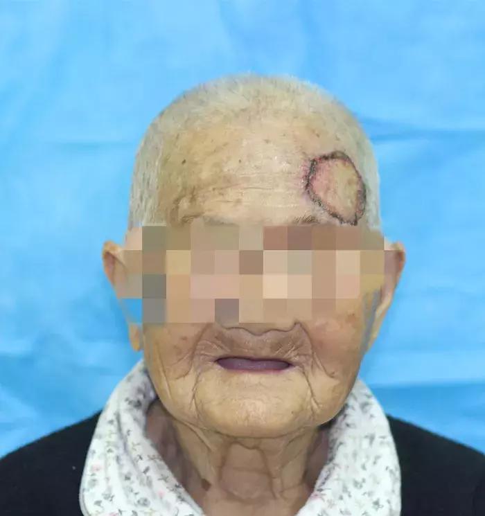 百岁老人额头长疮是怎么回事,百岁老人头有一个瘤