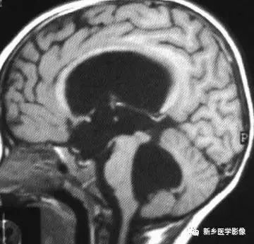 脑室影像学表现,脑室占位影像
