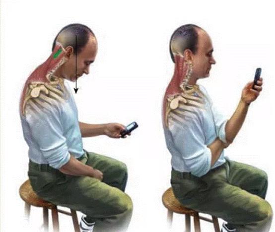 消除富贵包最简单最有效的方法,富贵包放血拔罐真的可以消除吗