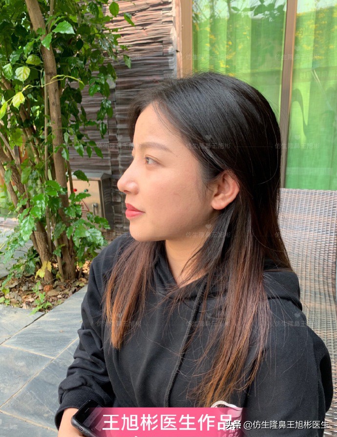 手术鼻头增厚能用什么方法弄,大鼻头高鼻梁缩小手术案例