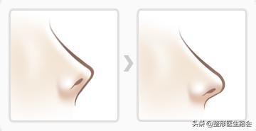 如何正确有效的缩小鼻翼,鼻翼大怎么缩小手术风险大吗