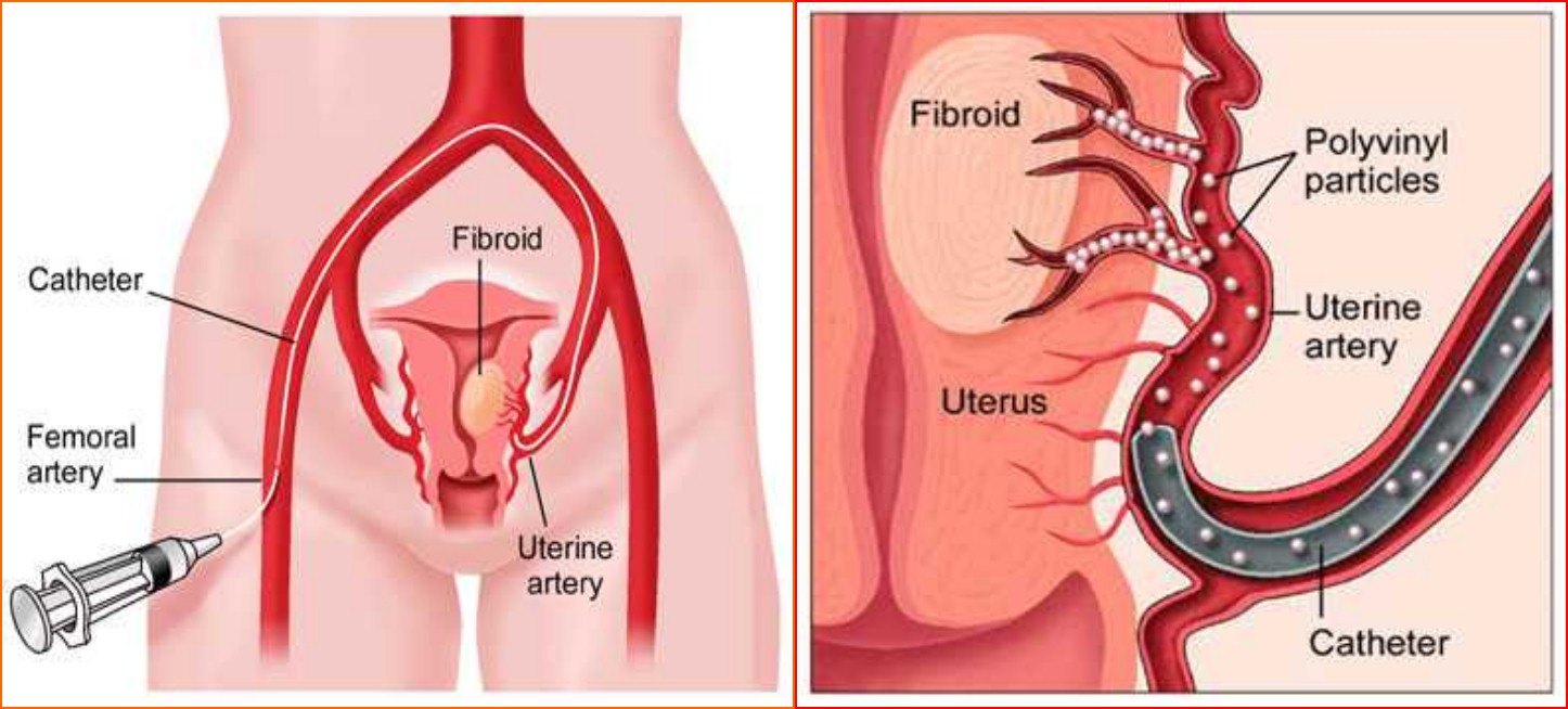 子宫腺肌症介入栓塞全国哪里好,子宫腺肌症介入栓塞治疗报销吗