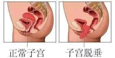 盆底康复，助力交往尴尬的女性