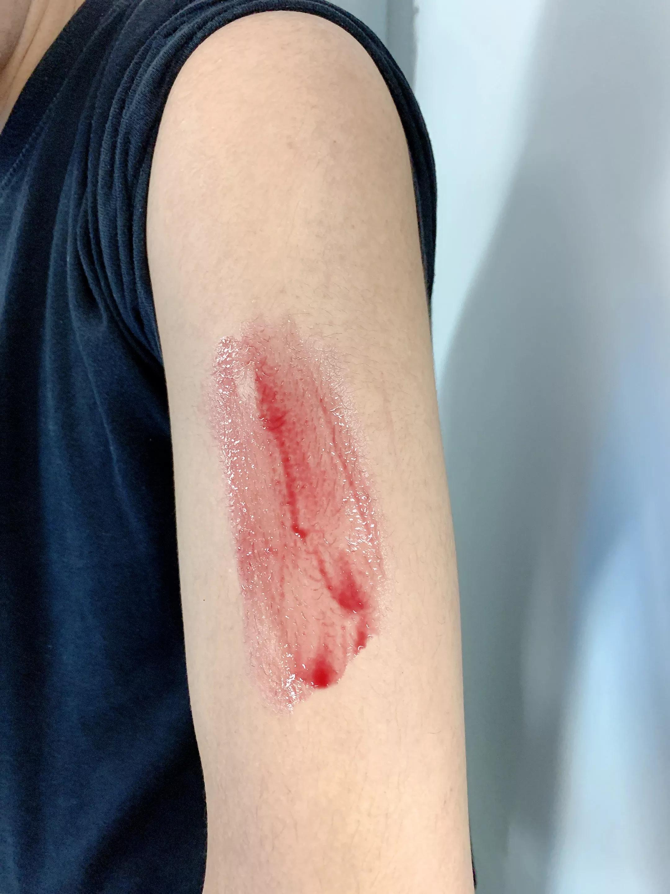 男朋友手臂上长很多小痘痘,男朋友手臂很多痘痘