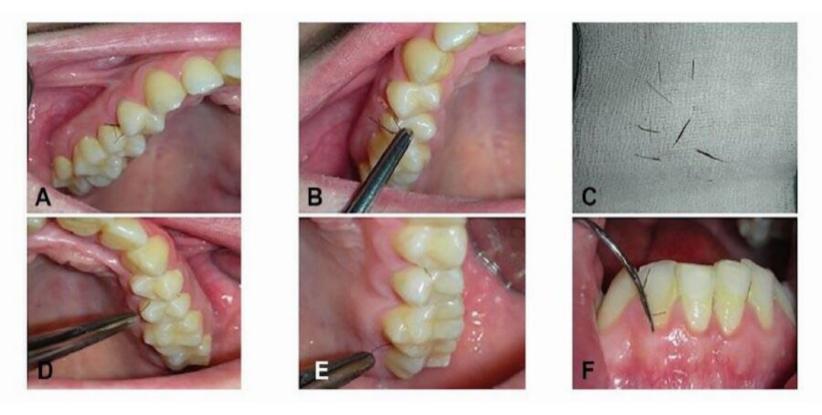 女性患多毛症,女孩患罕见疾病满脸长毛