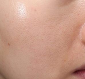 面部毛孔粗大有黑头在家怎么去除,面部暗黄毛孔粗大出油是什么原因