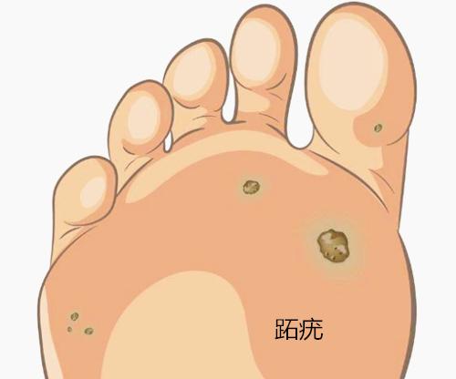 千万不要用鸡眼膏治疗跖疣,鸡眼跖疣到底怎么分辨