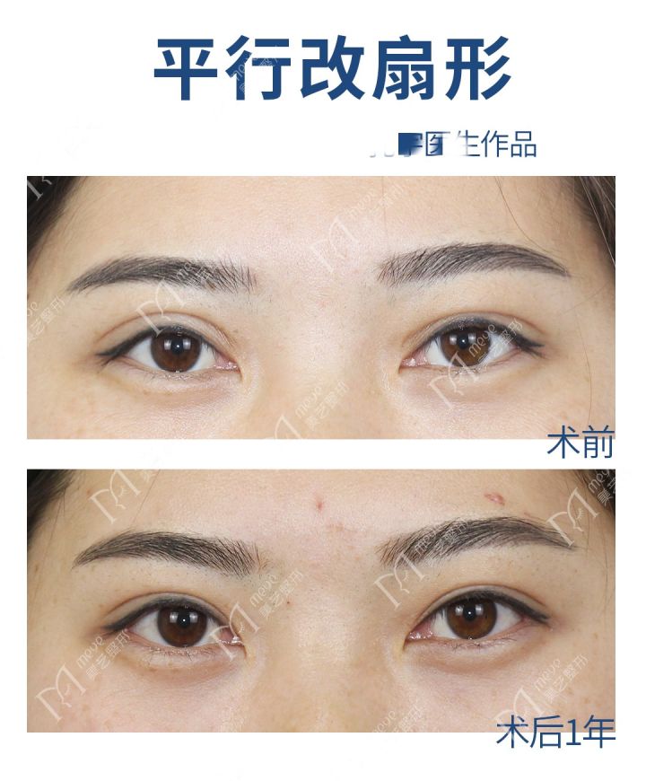 双眼皮割宽了怎么化妆,割双眼皮最宽能割几毫米