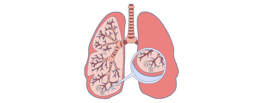 体检时发现结节增生囊肿怎么回事,查出息肉结节怎么办