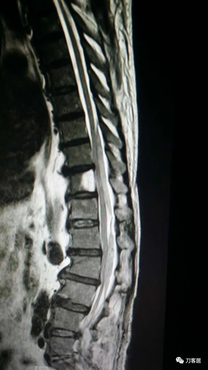腰椎手术切掉棘突,腰突微创后出血肿