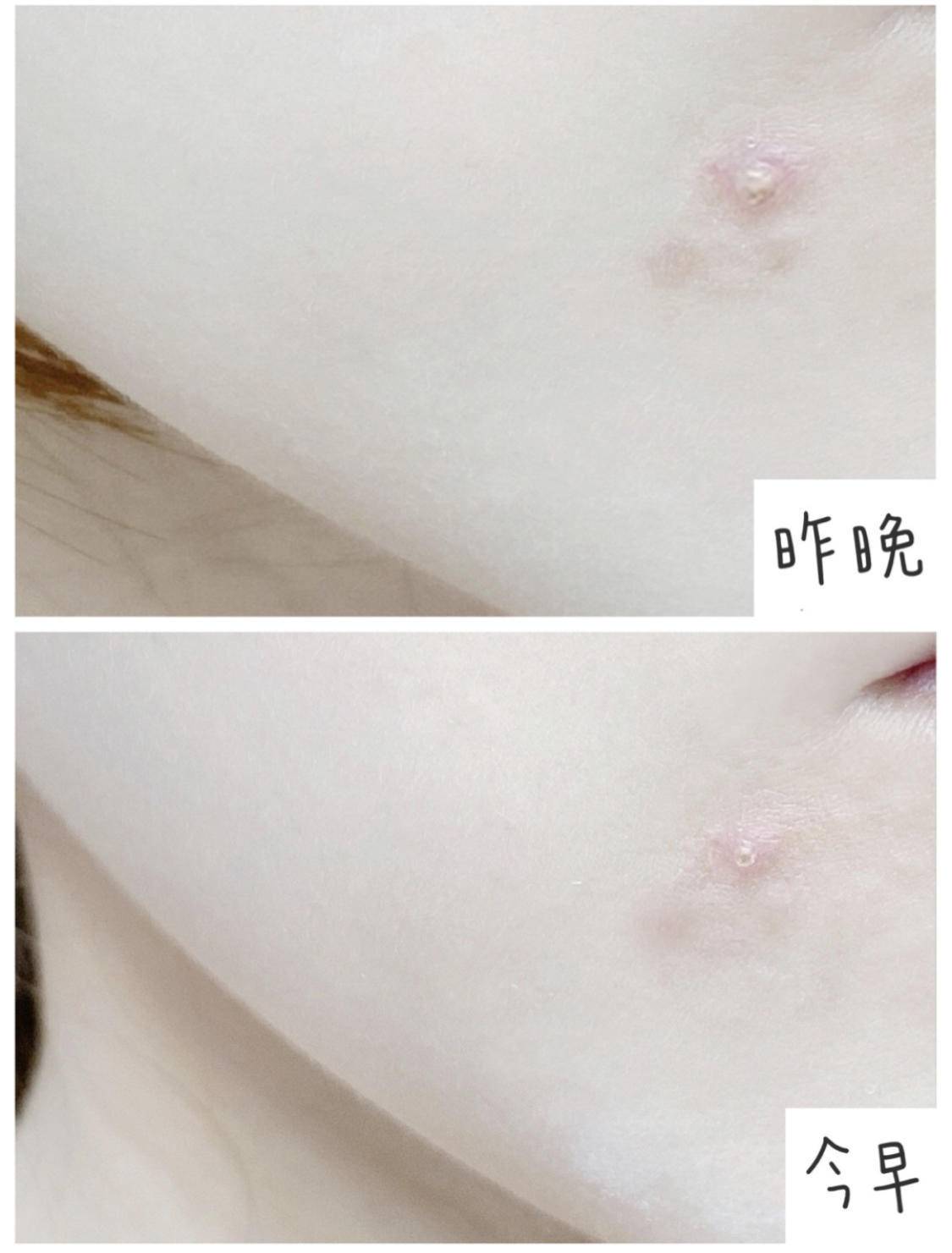 痘痘反反复复又红又疼又痒,痘痘反反复复有一层皮